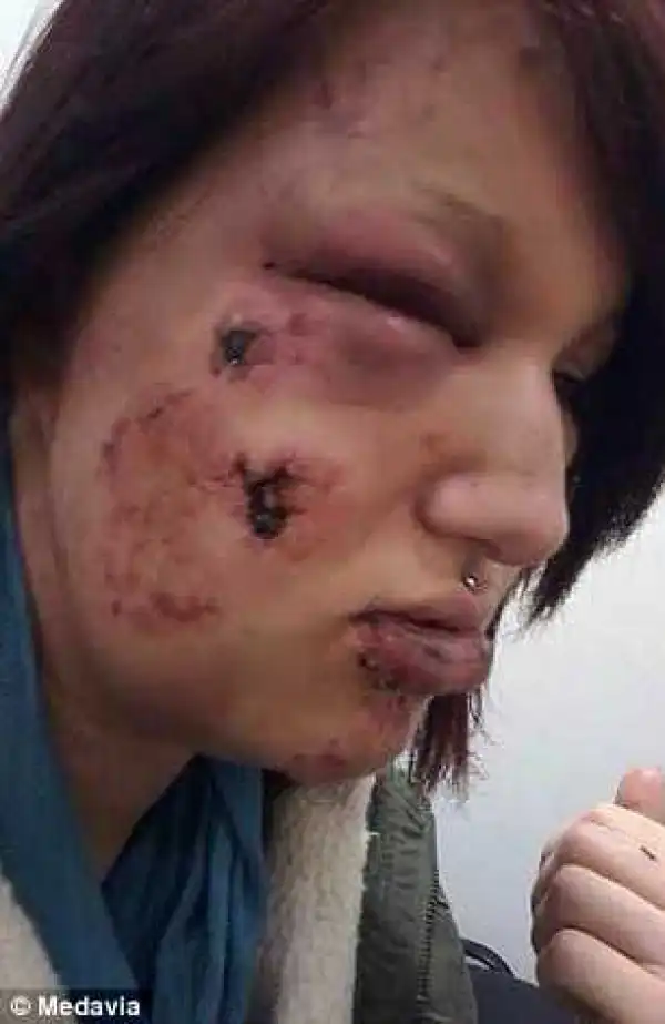 Graphic photos: Jealous ex-boyfriend bites woman